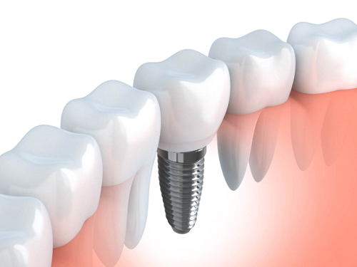 mini dental implant care